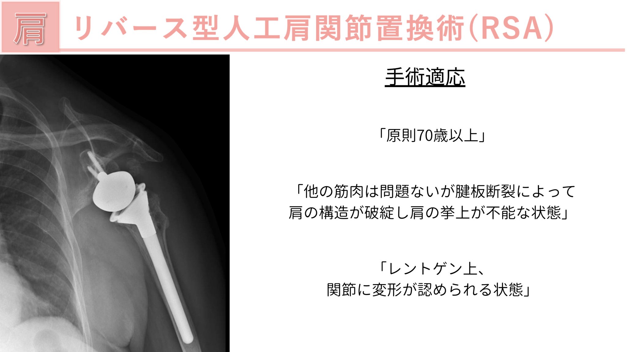 じんた|運動器疾患に特化した理学療法士 على X: じんた|運動器疾患に特化した理学療法士 على X: