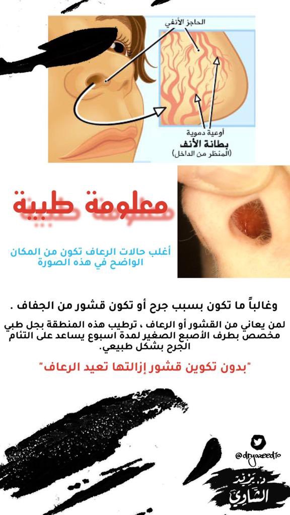 🩸هالايام يتكرر علي انه ينزل من خشمي #دم 

#رعاف #الانف