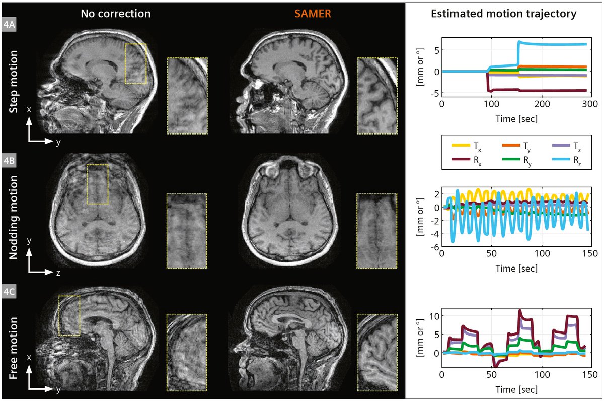 Antje Hellwich @antjehellwich.bsky.social (@antjehellwich) on Twitter photo On #WorldBrainDay let me draw your attention to Retrospective Motion Correction for Brain #MRI: A Technical Description of #SAMER by Daniel Polak (<a href="/SiemensHealth/">Siemens Healthineers</a>), et al.
Learn more at …ng.webassets.siemens-healthineers.com/221d76b6c91d33…
#magnetomworld #motioncorrection <a href="/MGHMartinos/">MGH Martinos Center</a> On #WorldBrainDay let me draw your attention to Retrospective Motion Correction for Brain #MRI: A Technical Description of #SAMER by Daniel Polak (<a href="/SiemensHealth/">Siemens Healthineers</a>), et al.
Learn more at …ng.webassets.siemens-healthineers.com/221d76b6c91d33…
#magnetomworld #motioncorrection <a href="/MGHMartinos/">MGH Martinos Center</a>
