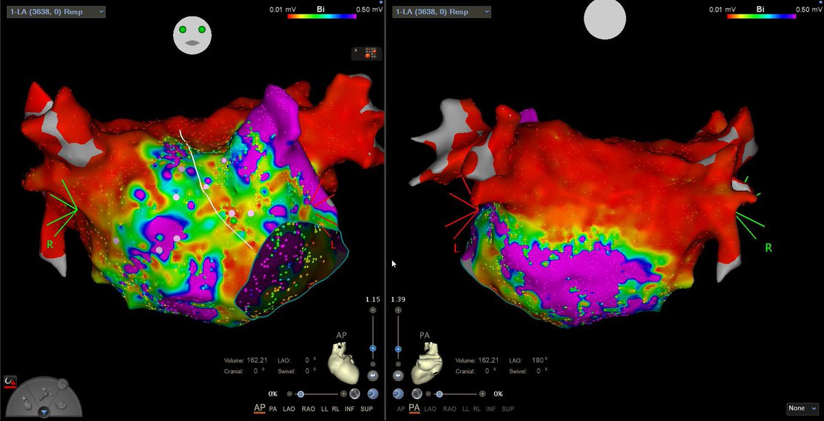Andrea Sarkozy (@andreasarkozy) on Twitter photo Large footprint PFA: a new era of persistent transmurality:
Initial PVI lesion set with postablation map and remap 10 months later at redo <a href="/HRMCBrussel/">Heart Rhythm Management Center</a> <a href="/LuigipannoneM/">LuigiPannone_MD</a> <a href="/cespon_maria/">María Cespón</a> @MiguelVldrbno <a href="/dogi84md/">Domenico Giovanni Della Rocca, MD</a> @deasnostos Large footprint PFA: a new era of persistent transmurality:
Initial PVI lesion set with postablation map and remap 10 months later at redo <a href="/HRMCBrussel/">Heart Rhythm Management Center</a> <a href="/LuigipannoneM/">LuigiPannone_MD</a> <a href="/cespon_maria/">María Cespón</a> @MiguelVldrbno <a href="/dogi84md/">Domenico Giovanni Della Rocca, MD</a> @deasnostos