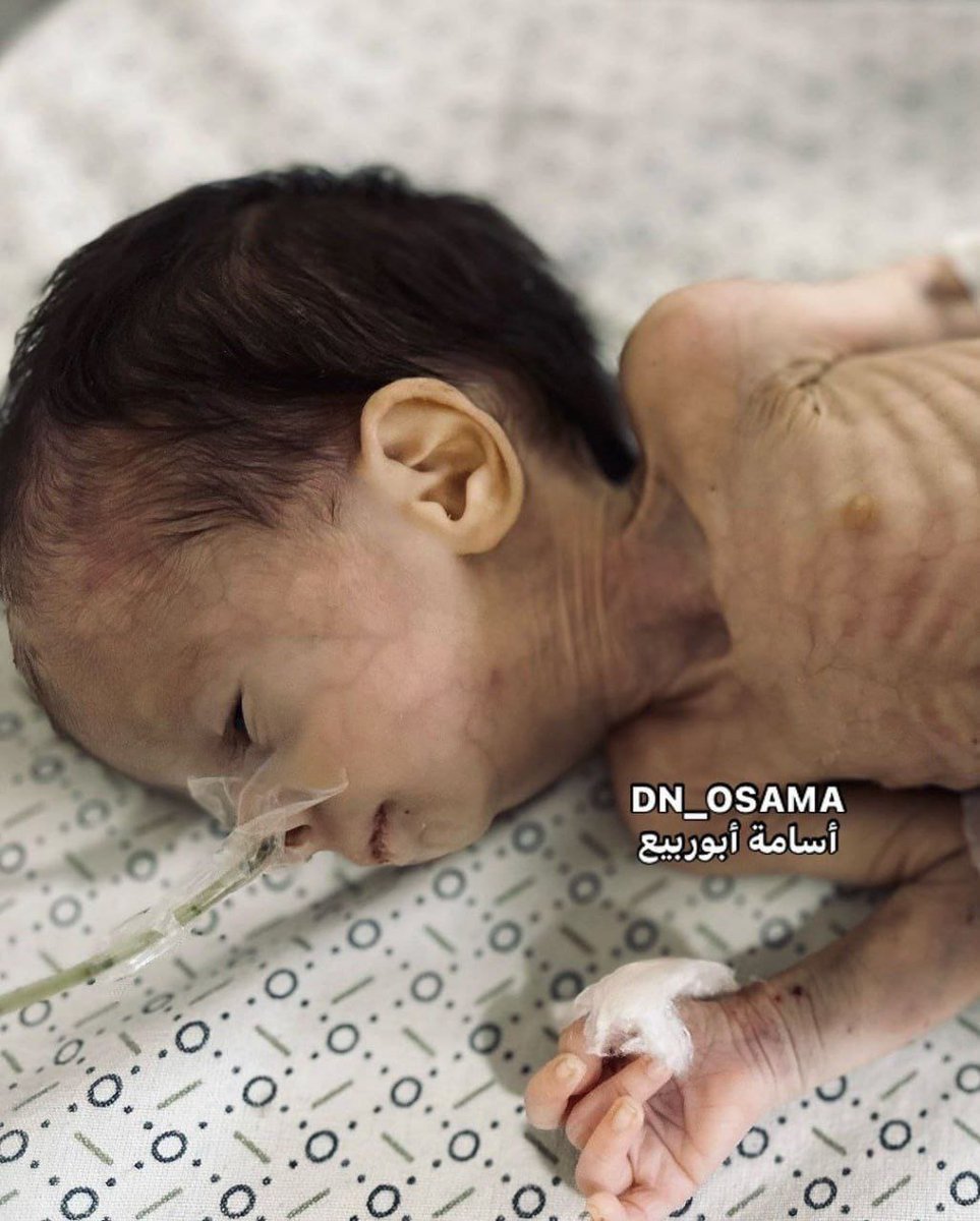 ismail_gh2's tweet photo. طفل في شمال غزة يعاني من سوء التغذية بفعل الحصار المطبق والحرب المتواصلة على القطاع

#شمال_غزة_يجوع https://t.co/lJFAEDl2In