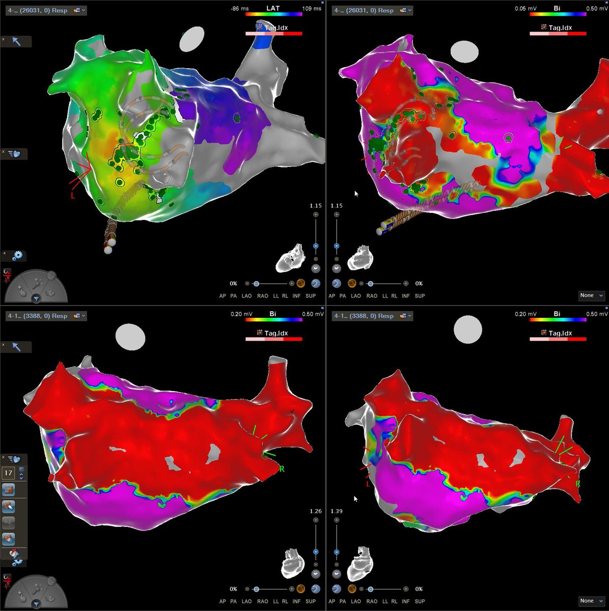 Stephen Tuohy (@stephentuohyep) on Twitter photo First day of cases in Ireland using PulseSelect PFA catheter. During PVI onset of LA flutter. Carto V8 system map with complex signals noted at early activation site left anterior carina. Single pulse application terminated flutter. PVI &PWI. <a href="/khaldountarakji/">Khaldoun Tarakji</a> #epeeps First day of cases in Ireland using PulseSelect PFA catheter. During PVI onset of LA flutter. Carto V8 system map with complex signals noted at early activation site left anterior carina. Single pulse application terminated flutter. PVI &PWI. <a href="/khaldountarakji/">Khaldoun Tarakji</a> #epeeps