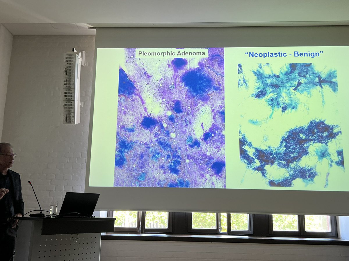 EfcsYoung's tweet image. Facing mistakes and mishaps in Salivary Gland Cytopathology with @sza_jhcyto 👀 🧠 💭 #IAC #ECC2024 learning from mistakes #IACTutorialLeipzig #cytology #cytopath
