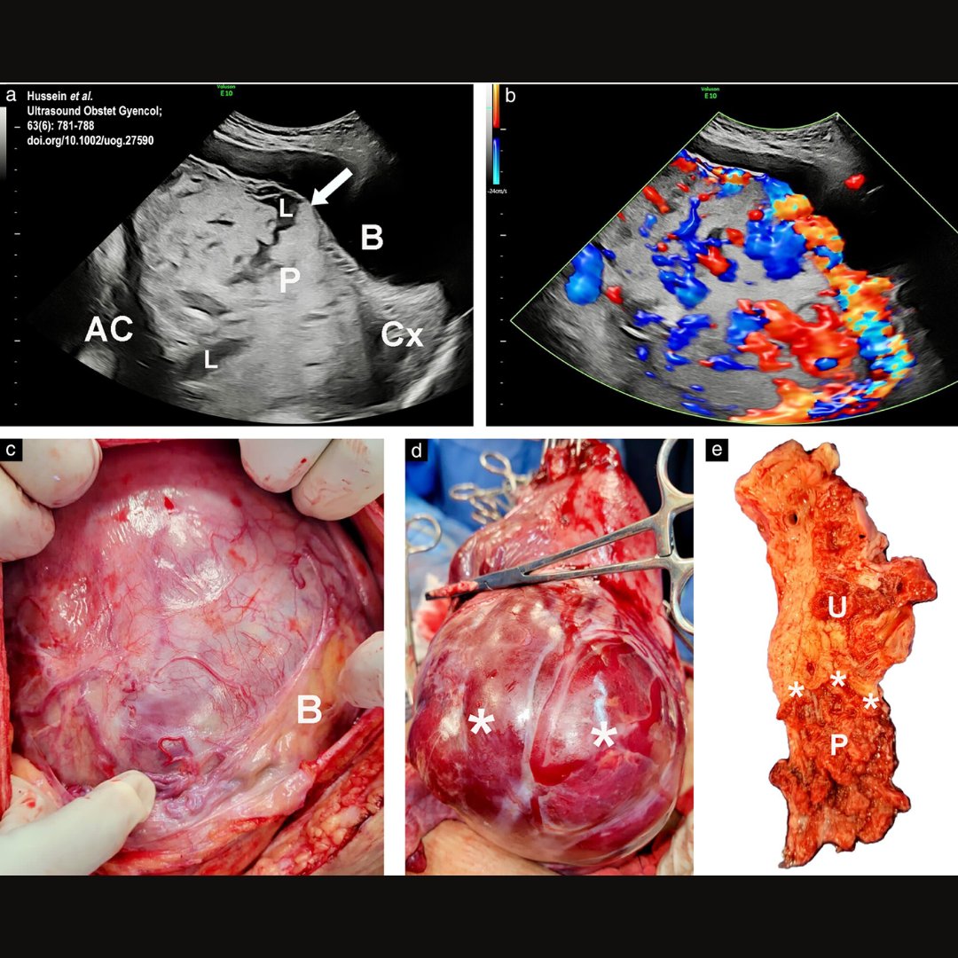Open-access article by Hussein et al. in June #UOGJournal reports that preoperative ultrasound examination is useful in evaluation of intraoperative bladder injury risk in patients with prior Cesarean delivery with a low-lying placenta or placenta previa. bit.ly/4bUOezz