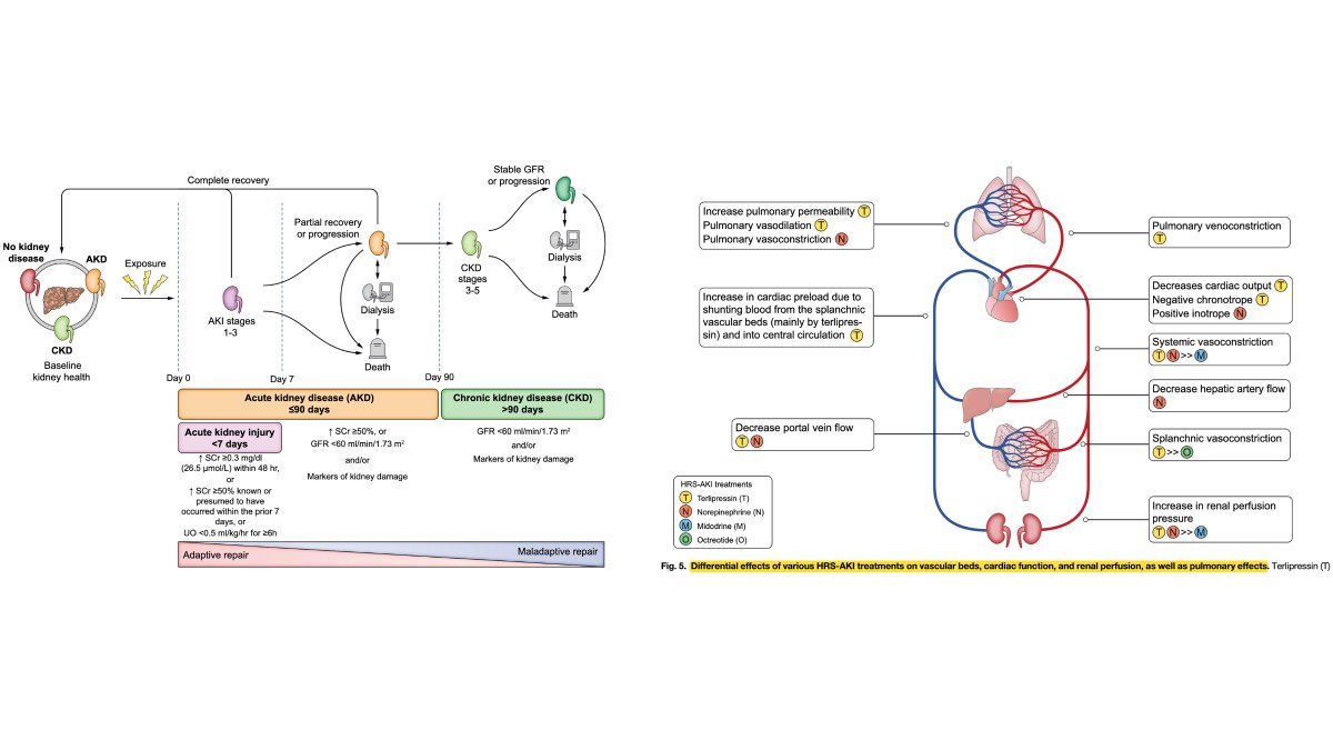 Nuevo consenso de expertos sobre lesión renal aguda (AKI) en pacientes con #cirrosis, un problema frecuente y grave, asociado a alta morbimortalidad

🔬📚  Importancia de un enfoque personalizado para el manejo de AKI en cirróticos, considerando tanto marcadores funcionales como