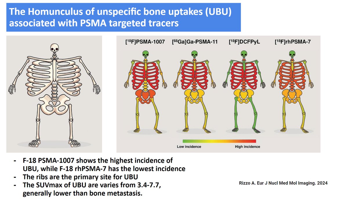 The Homunculus for unspecific bone uptake (UBU) seen on PSMA PET imaging, for more details link.springer.com/article/10.100… #prostatecancer #psma #psmapetct