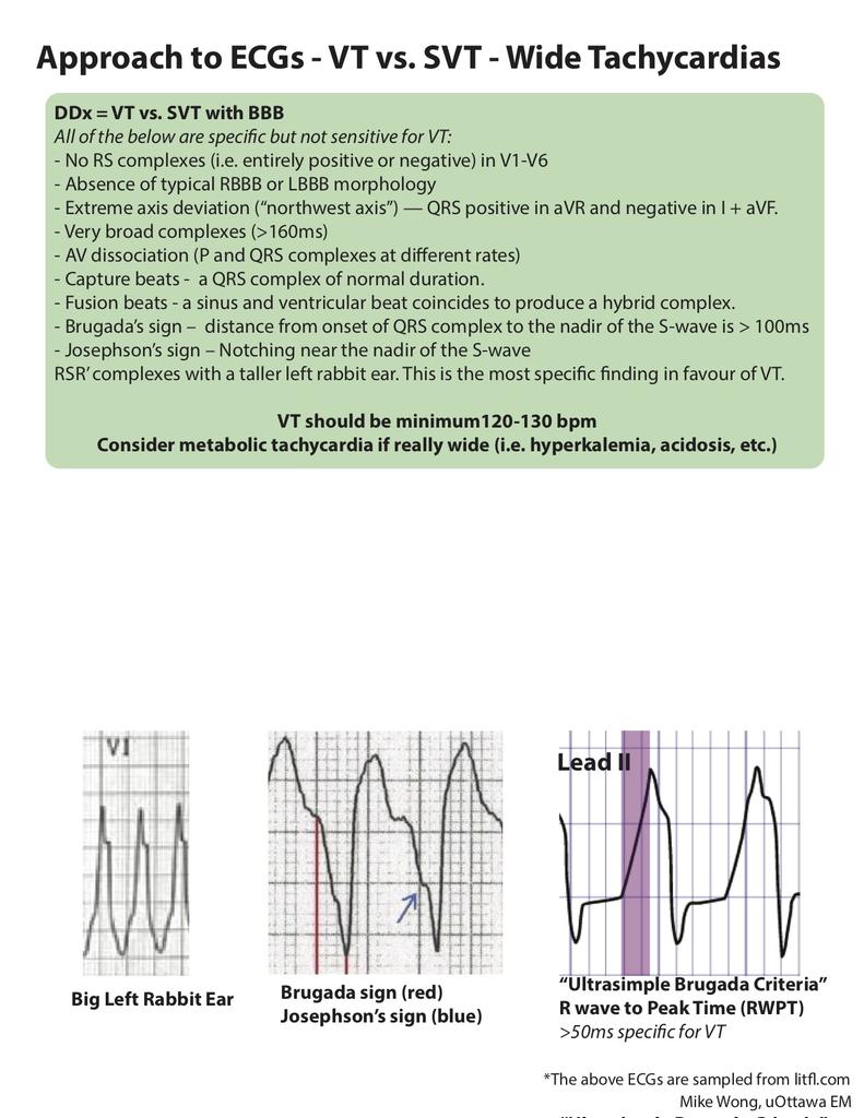 ZHeart11768530's tweet image. 🔴 Approach to ECGs - VT vs. SVT - Wide Tachycardias

🔹DDx = VT vs. SVT with BBB
🔹All of the below are specific but not sensitive for VT:

#VT #VTach #SVT #Comparison #VentricularTachycardia #Versus #ecg #ekg #cardiology #diagnosis #electrocardiogram 
 #FOAMed #MedEd