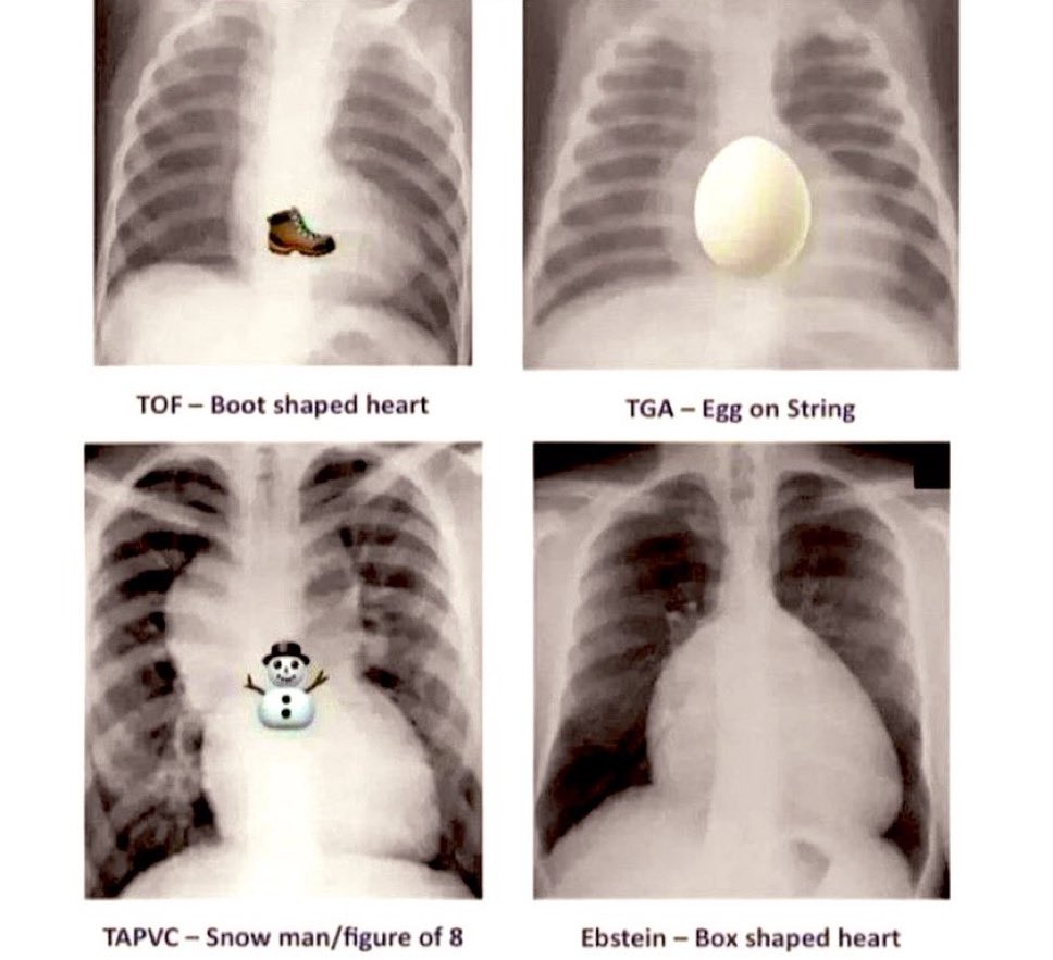 Congenital heart disease radiology signs 🤩: 

#Radiology #cardiology