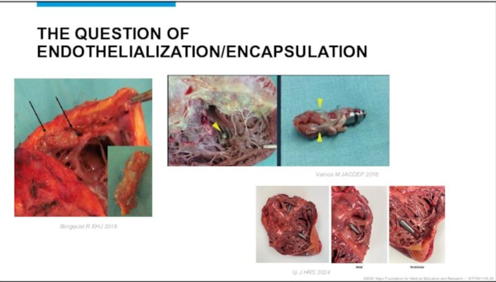 Siva Mulpuru MD MPH (@sivamulpurumd) on Twitter photo #DeviceSummit2024 <a href="/MayoClinicCV/">Mayo Clinic CV</a> Hicham El Masry discussing how do lifecycle management for leadless pacemakers. When to take out old devices? <a href="/nicktanCV/">Nicholas Tan</a> #DeviceSummit2024 <a href="/MayoClinicCV/">Mayo Clinic CV</a> Hicham El Masry discussing how do lifecycle management for leadless pacemakers. When to take out old devices? <a href="/nicktanCV/">Nicholas Tan</a>