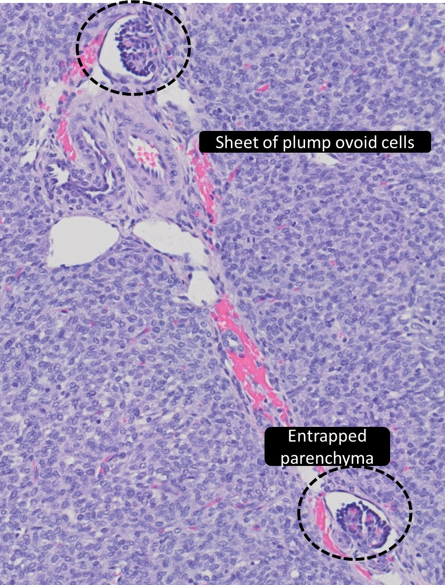 Kidney mass in 3-week-old👶 , diagnosis?
a) nephroblastoma, blastema-predominant
b) clear cell sarcoma of the kidney
c) congenital mesoblastic nephroma
#GUPath #PediPath #PathTwitter #Pathology
WSI🔬 digitalscope.org/ViewerUI/?Slid…
