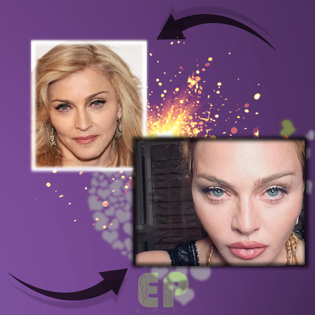 ✅ Madonna Louise Ciccone'nin geçirdiği estetik operasyonları inceledik ve geçirdiği tahmin edilen bazı estetik operasyonları paylaşıyoruz.

📩Bilgi ve Randevu İşlemleriniz İçin Bize Mesaj Gönderebilirsiniz.

estepowerclinic.com

#estepower