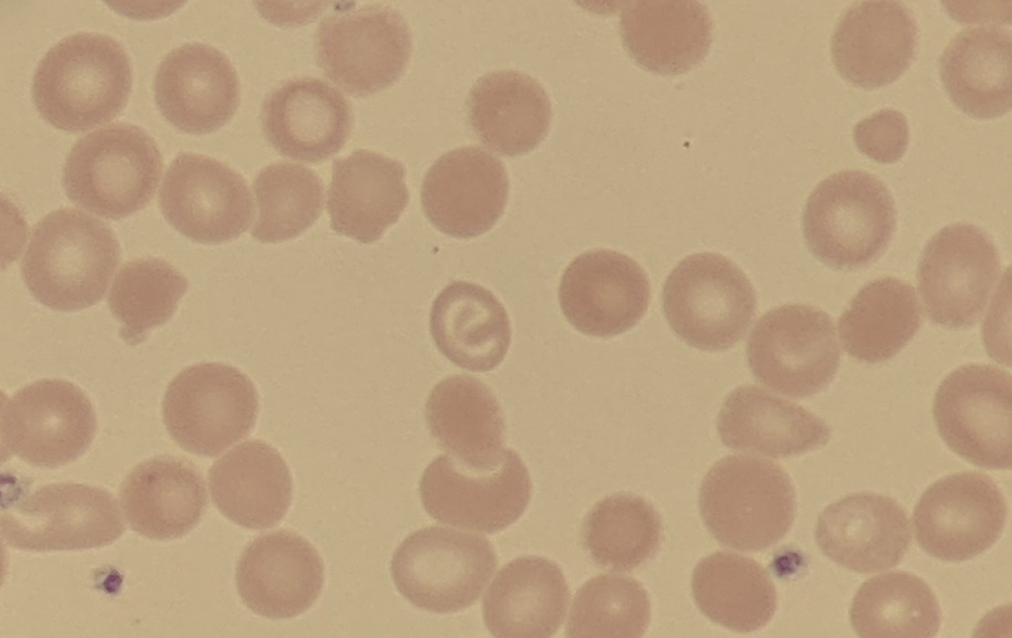BloodScientist's tweet photo. Just saw the chillest red blood cell under the microscope today. Dude's got a whole entire existential crisis goin' on in his center. 

Or maybe it just wants to be internet famous! 

#RedCells #MicroscopeLife https://t.co/1CPZi4BaCt