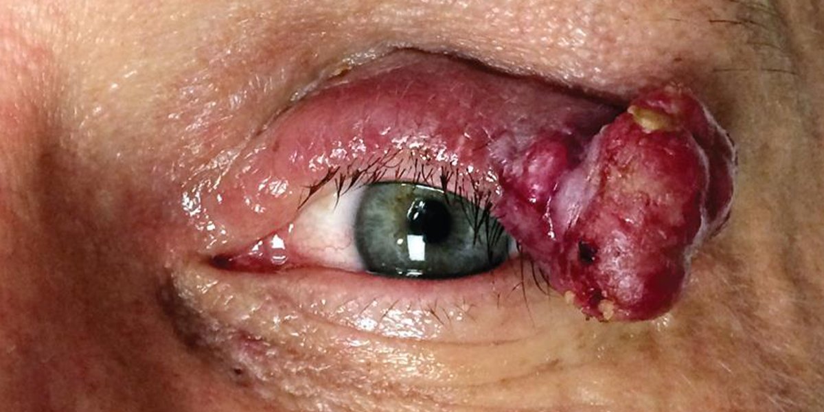 What is #Merkelcell carcinoma and where did the name come from? #ocularoncology #ophthalmology ow.ly/RIzW50S9XsM