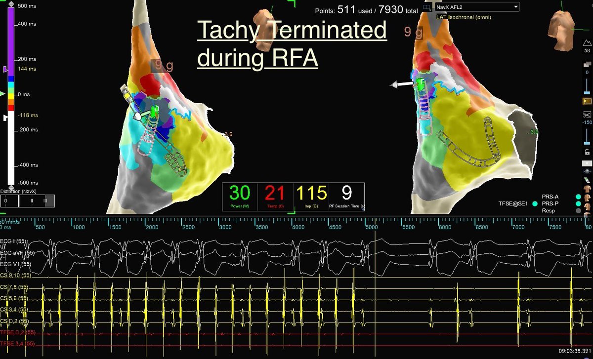 Yogesh (@yogesh_ep) on Twitter photo 1/2,HDG+Tactiflex used in 1.5yr/M #CHD patient with AAFL,Atrial #ILAM on CS pacing perfectly correlates wit Tachy isthmus,procedure done by Dr. Azlan <a href="/paklan1967/">Lan</a> IJN,Malaysia <a href="/DrRoderickTung/">Roderick Tung</a> <a href="/hikmetyorgun/">Hikmet Yorgun</a> <a href="/jeffrey_vinocur/">Jeffrey M Vinocur</a> <a href="/RChung_EP/">Roy Chung</a> <a href="/EPWoodsShop/">Christopher Woods</a> <a href="/Hapa_EP/">Kevin Brady</a> <a href="/mike_lean/">Mike Lean</a> <a href="/AbbottCardio/">Abbott Cardiovascular</a> 1/2,HDG+Tactiflex used in 1.5yr/M #CHD patient with AAFL,Atrial #ILAM on CS pacing perfectly correlates wit Tachy isthmus,procedure done by Dr. Azlan <a href="/paklan1967/">Lan</a> IJN,Malaysia <a href="/DrRoderickTung/">Roderick Tung</a> <a href="/hikmetyorgun/">Hikmet Yorgun</a> <a href="/jeffrey_vinocur/">Jeffrey M Vinocur</a> <a href="/RChung_EP/">Roy Chung</a> <a href="/EPWoodsShop/">Christopher Woods</a> <a href="/Hapa_EP/">Kevin Brady</a> <a href="/mike_lean/">Mike Lean</a> <a href="/AbbottCardio/">Abbott Cardiovascular</a>