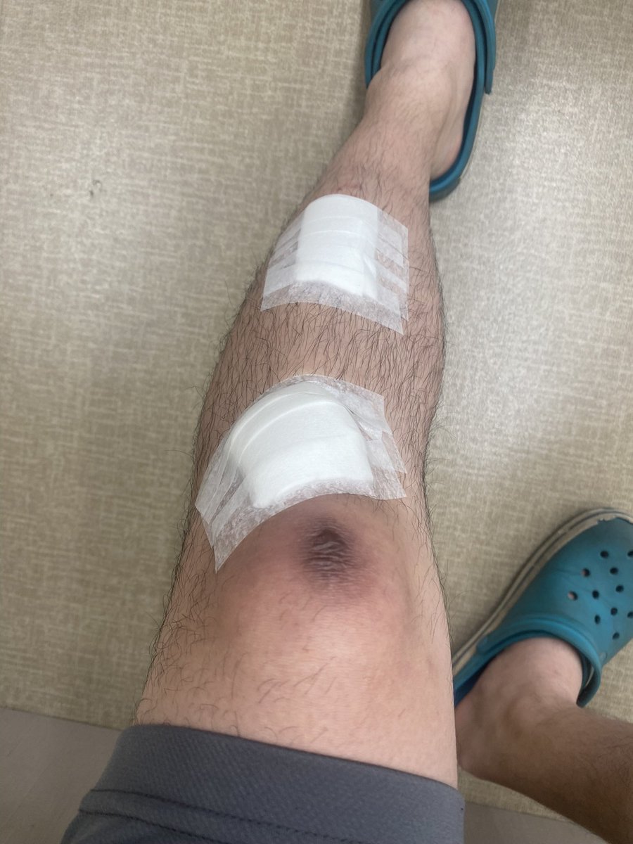 DaikiMazda's tweet photo. 年甲斐もなく草野球で膝下エグれましたww
気持ちだけは負けない！
常に全力プレー名誉の負傷です🤕笑

#草野球 #名酸アルゴンズ #ドラゴンズ #こどおじ https://t.co/LZN8z6kMVk