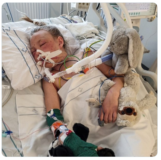Mirjam152's tweet photo. Dit is Luna, een 9-jarig Zweeds meisje in juli 2022. Ze ligt in het ziekenhuis nadat ze door de 15-jarige Abushi Shamse Kamal geslagen, verkracht en gewurgd is. Bij wonder overleefde ze. Kamal had net een week zijn permanente verblijfsvergunning binnen. https://t.co/7LlAvqTlYL