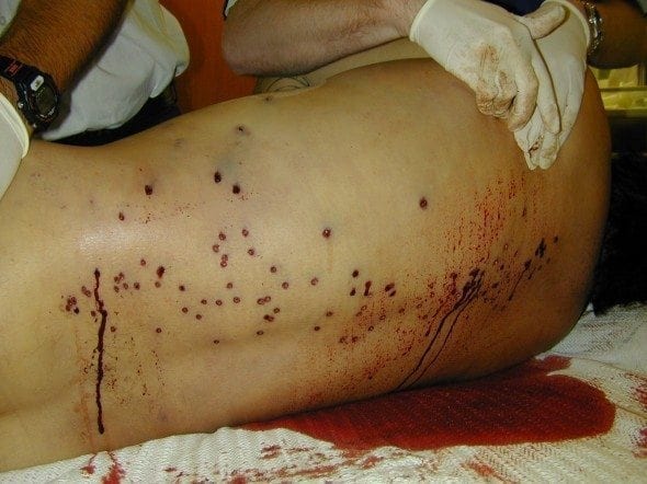 LITFLblog's tweet photo. 3am ER drama: 23-year-old with gunshot wounds, vitals plummeting. It’s a race against time, blood, and pressure. Will a massive transfusion be the lifeline he needs?  https://t.co/BuRdFIux15

#CriticalCare #TraumaResponse #MedEd #MedTwitter #FOAMed https://t.co/G2rnDEYin8