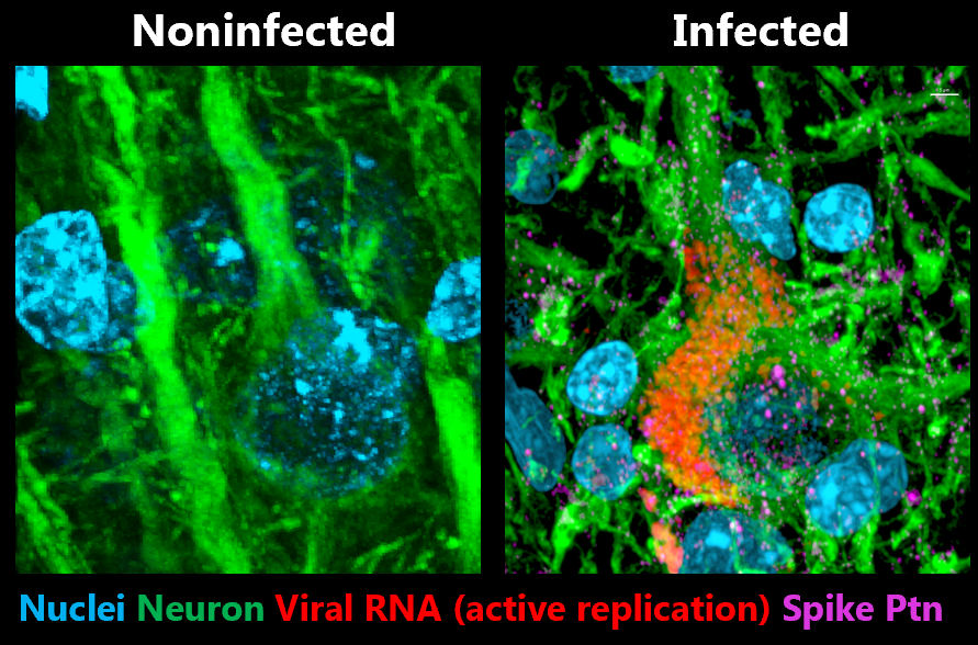 DaniBeckman's tweet photo. It is #COVID19 that is leaving people with neurological problems. It is not the vaccine. 
SARS-CoV-2 spike mRNA vaccine does not contain the intact virus. Only active virus infecting the brain can replicate inside the neuron, as shown in the image below. It is crystal clear. https://t.co/aTDnxQTeUH