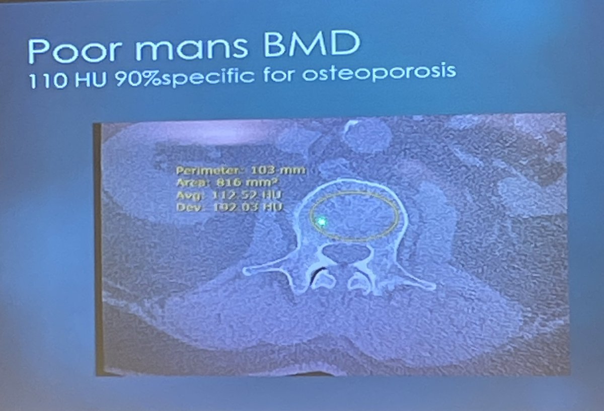 CleSpineReview's tweet image. Bone density pearl from Doug Orr: use Hounsfield Units (HU) on CT in ONLY cancellous bone (make sure you leave out cortical bone. &lt;= 110 HU ~ osteoporosis #spine #CLESpine24