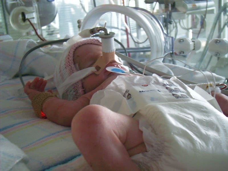 Systematic review comparing extubation success of nasal high freq oscillation vs CPAP in #preemies declares nHFOV the winner
NHFOV demonstrated a signif ⬇️ in the intubation or reintubation rate (p&lt;0.01, relative risk=0.45, 95% CI 0.37 to 0.55)
pubmed.ncbi.nlm.nih.gov/38228382/
#neoTwitter