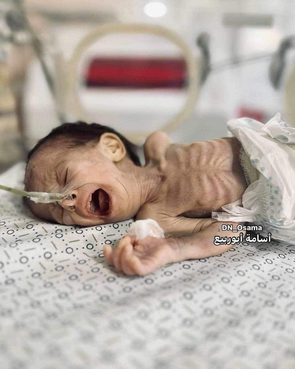 AbujomaaGaza's tweet photo. This Palestinian baby was born during the ongoing Israeli genocide on the #Gaza_Strip. 

She’s not been named yet. 

Today, she tragically passed away due to starvation and malnutrition as result of the brutal Israeli siege and war of starvation.
#Famine_in_North_Gaza
#شمال_غرة_يموت_جوعاً