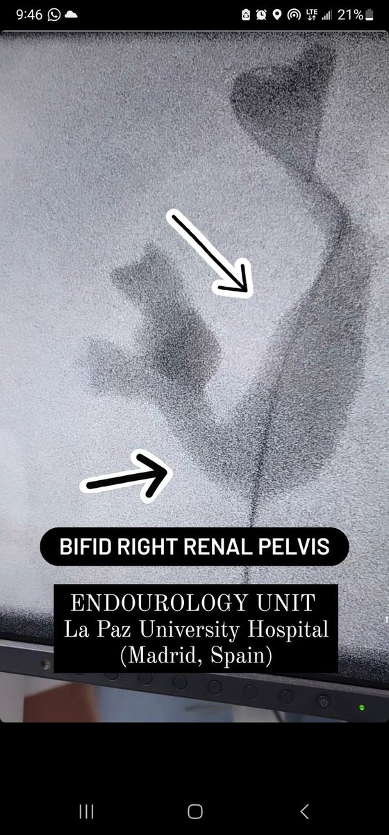 Bifid Right Renal Pelvis
#Pyelography