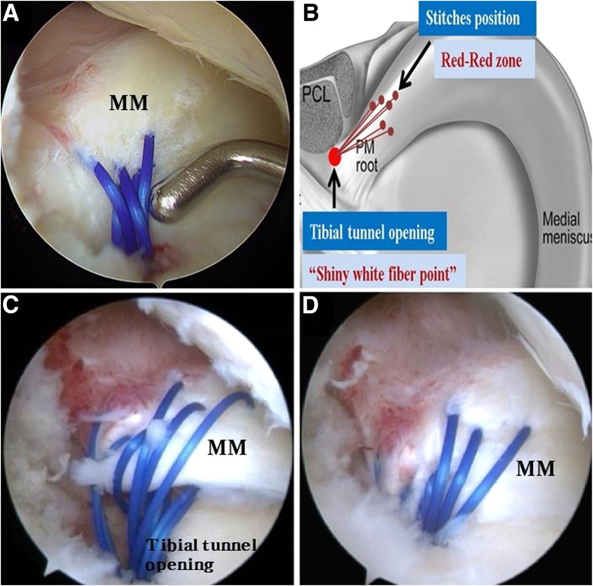 Simplified Technique for Arthroscopic Repair of the Meniscus Root Tear of the Knee ow.ly/1uMc50SjCr9 #knee #arthroscopy #meniscus