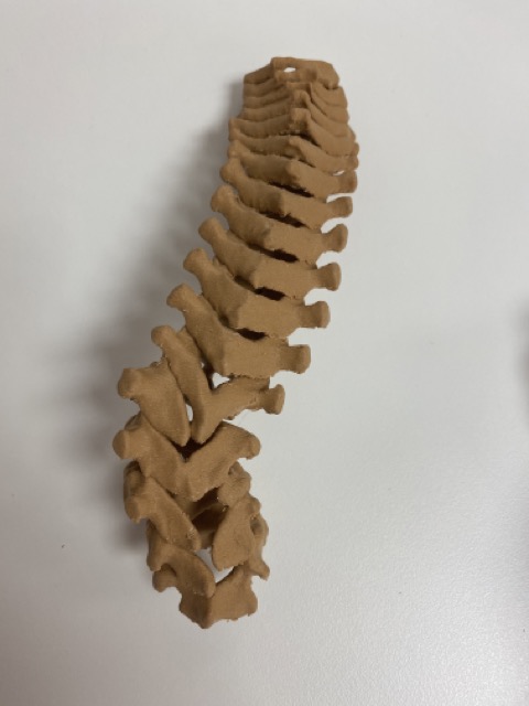 British Scoliosis Society (@britscoliosis) on Twitter photo Did you know that congenital scoliosis can be associated with
Tracheo-oesophageal fistula
Anorectal anomalies
Congenital cardiac anomalies
Renal anomalies
Limb abnormalities
#ScoliosisAwarenessMonth #June #SAM2024
<a href="/SRS_org/">Scoliosis Research Society</a> <a href="/Scoliosis_SR/">Scoliosis Support & Research</a> <a href="/BASSspine/">British Association of Spine Surgeons</a> Did you know that congenital scoliosis can be associated with
Tracheo-oesophageal fistula
Anorectal anomalies
Congenital cardiac anomalies
Renal anomalies
Limb abnormalities
#ScoliosisAwarenessMonth #June #SAM2024
<a href="/SRS_org/">Scoliosis Research Society</a> <a href="/Scoliosis_SR/">Scoliosis Support & Research</a> <a href="/BASSspine/">British Association of Spine Surgeons</a>