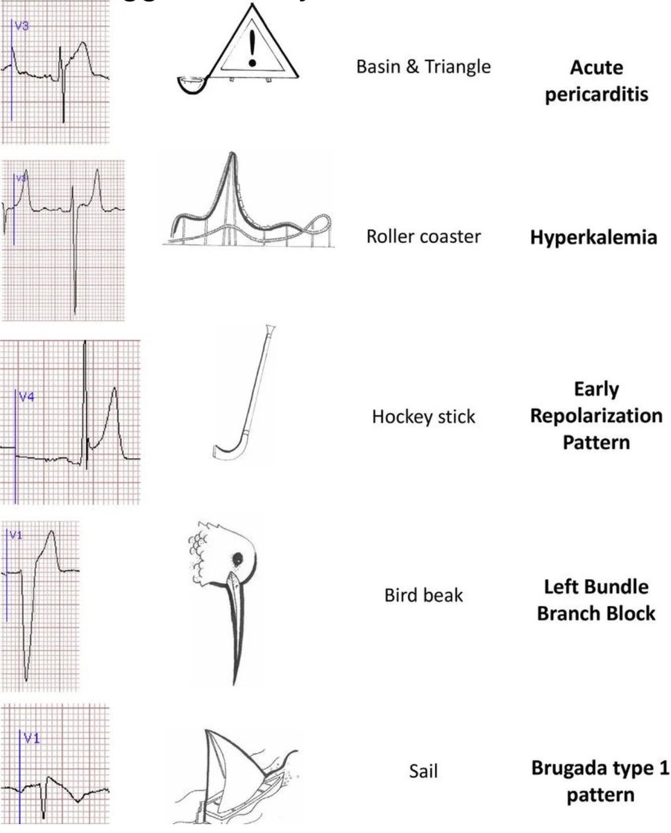 Interesting to remember cardiac signs via cardiobeat by beat