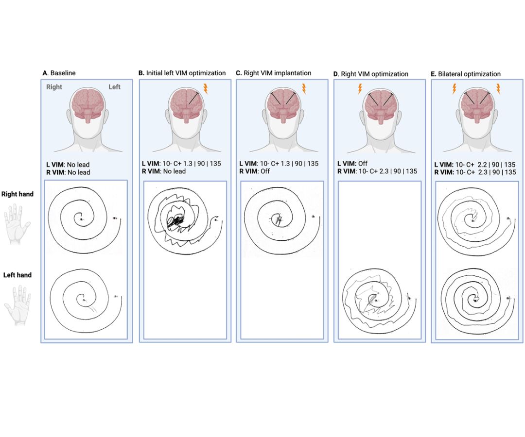 🥳Congrats to Fixel Institute grads Dr. Ariane Carpentier and Dr. Jason Chan, and researchers Dr. Wong and Dr. Okun, on their paper in the Tremor and Other Hyperkinetic Movement Journal. Read it here: ow.ly/6bs250SxeWz Well done, Doctors!