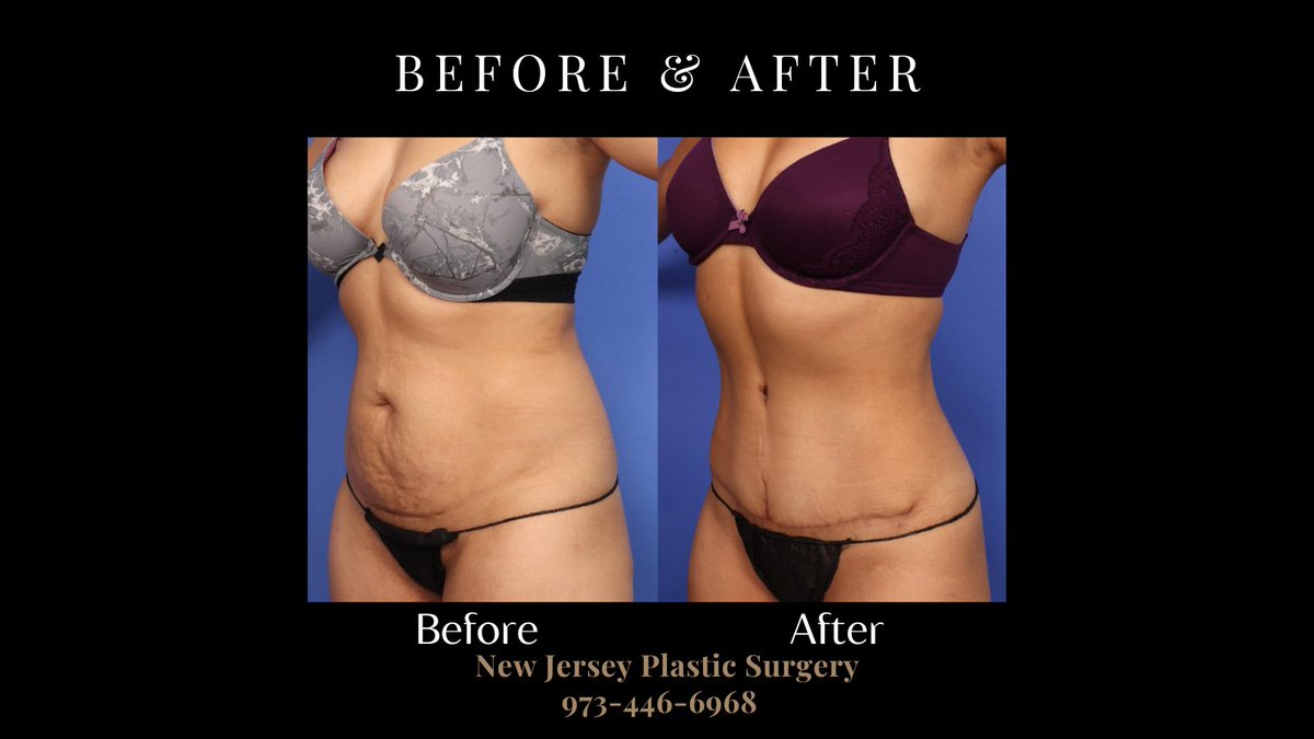 Transform your silhouette with an abdominoplasty at NJPS! Meet with one of our amazing surgeons and learn how we can flatten and transform your midsection. Schedule your consultation today by calling 973-446-6968.

#Abdominoplasty #TummyTuck

newjerseyplasticsurgery.com/consultation/