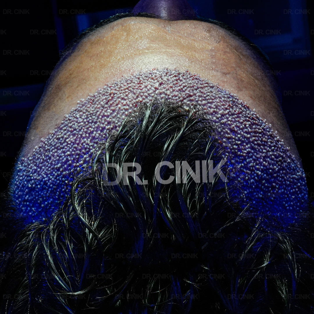 drcinikofficial's tweet image. From sparse to sensational! 🌟 2.8K grafts = 1 step closer to a full head of hair. 💪 

For more information 👇

📲 +90 549 641 37 01
📩 info@drcinik.com
🌐 drcinik.com

#Grafts #HairTransplant #DrCinik #DHI #HealthToursim #FUE