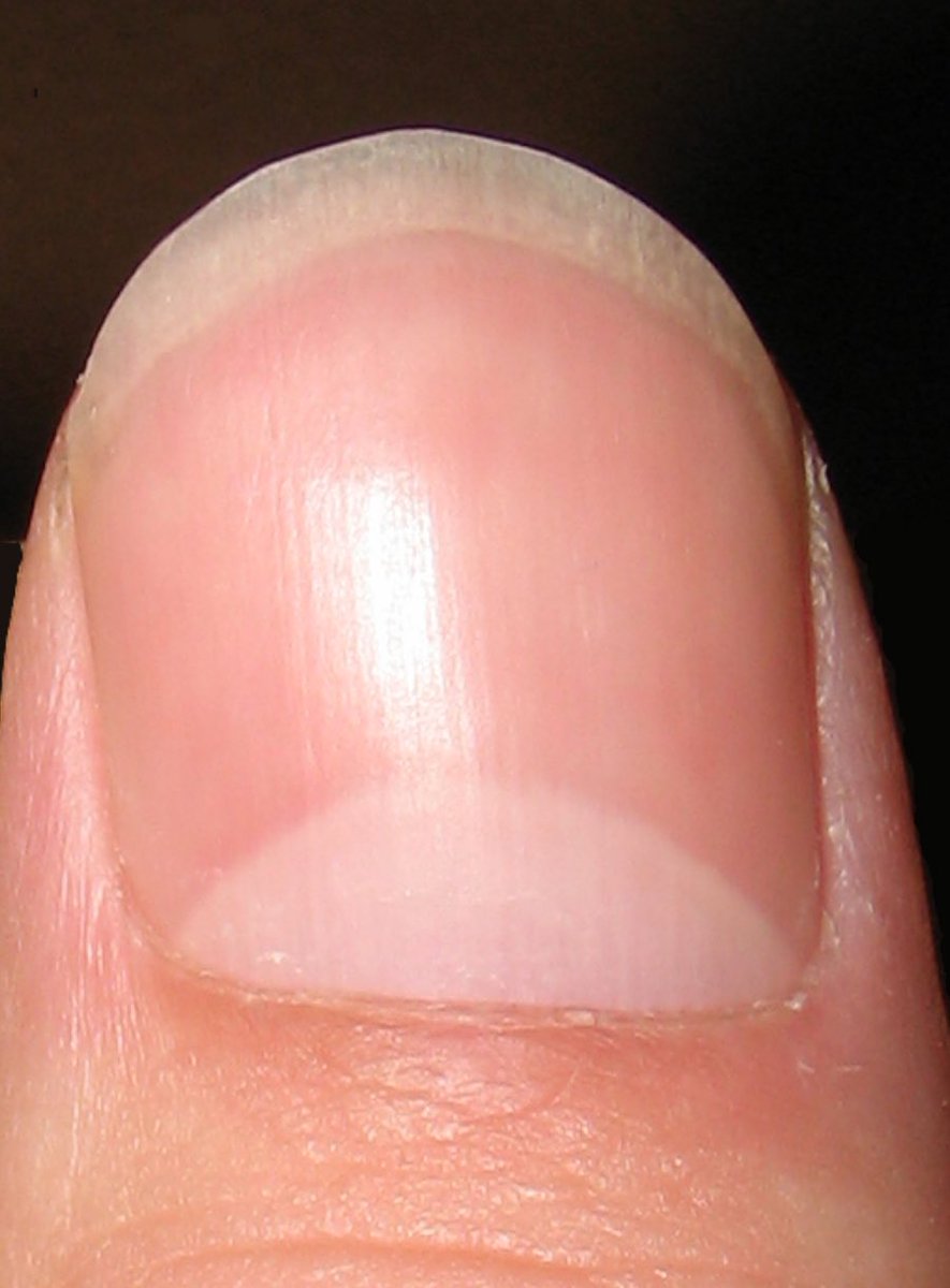 MarcelaSaebL's tweet photo. A ver comunidad tuitera van los cuidados básicos de las uñas, en especial la de los pies.  
🚨NO acuda nunca al podólogo. 
1. Las uñas se liman en línea recta. No se cortan y no se usan alicates para cortar “pellejos”.   
2. Se aplica crema de urea alrededor.  
3. Se seca la piel entre los dedos. 
4. Se usa calzado cómodo. 
5. Y las enfermedades de la uña, las revisa la #dermatología.