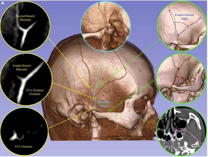 Check out June's #ONSNewIssue paper, tinyurl.com/4sppwunf, regarding TPF flap transposition through the infratemporal-maxillary-pterygoid tunnel to the ventral skull base in difficult reconstruction cases, which made last month's cover! 

<a href="/CNS_Update/">CNS</a> <a href="/NeurosurgeryCNS/">Neurosurgery Publications</a>