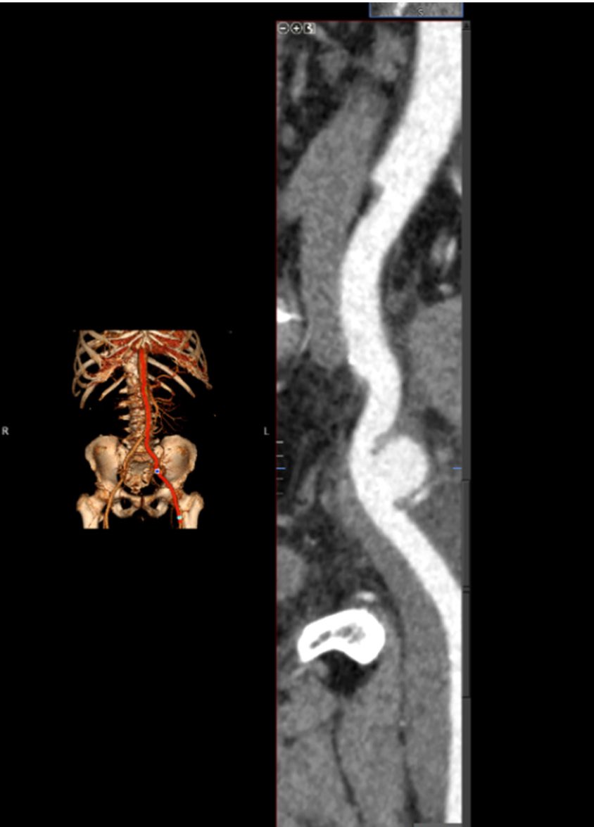 Salvage of a kidney transplant with a mycotic extrarenal pseudoaneursy... sciencedirect.com/science/articl…