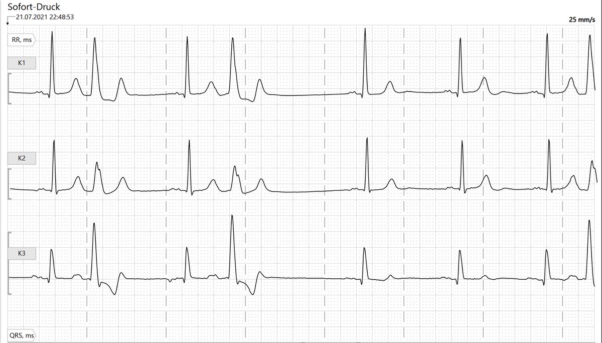 ecgandrhythmRoe's tweet photo. For medical students: PACs or PVCs? https://t.co/4UJF4qVhwM