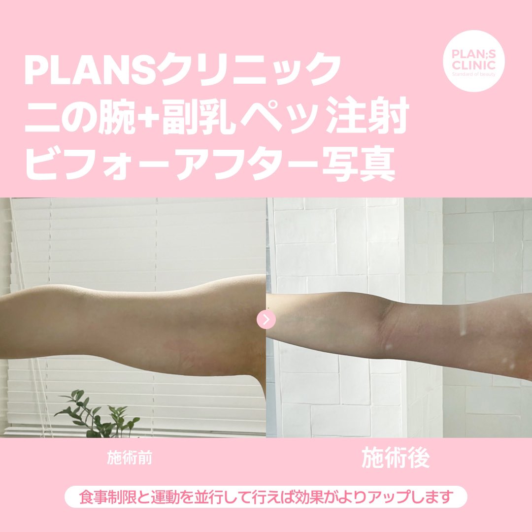 プランエス　脂肪 韓国プランエスクリニックでペッ注射（脂肪溶解注射）とトリプル