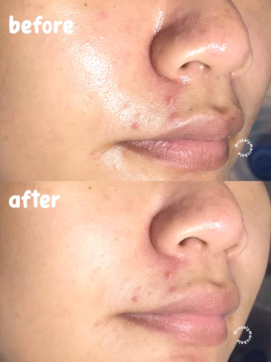 roselymarchela's tweet photo. sama aku juga oily!

first impression aku ketemu forebie ini dia beneran hempasin semuaa minyak di wajah akuu tanpa bikin wajah aku kerasa ketarik sama sekali 😳💗

tim oily skin pasti paham banget https://t.co/W7xoH7OSI4
