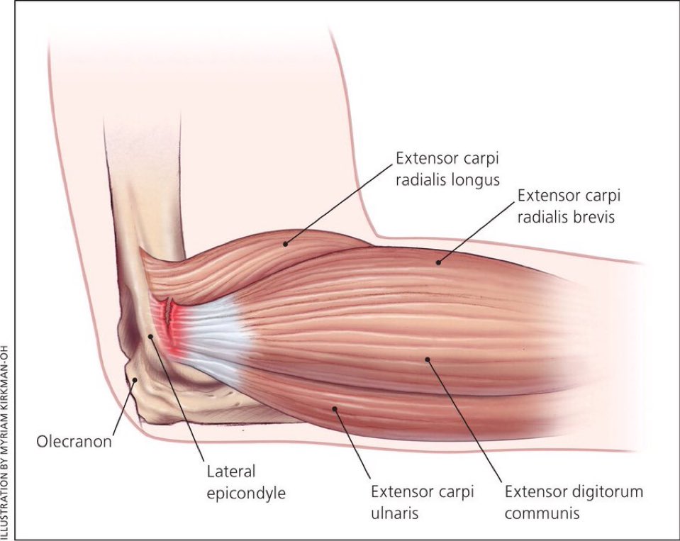 Omid_HopeUni's tweet photo. Tennis Elbow

▶️Overuse tendinopathy
▶️Annual incidence 👉🏾1%-3%
▶️Most patients in 30s &amp; 40s 
▶️maximal tenderness ~1cm distal to epicondyle at origin of extensor carpi radialis brevis
▶️Pain &amp; ⤵️strength with resisted gripping, wrist supination/extension

https://t.co/FTmN4iqIUG https://t.co/M00stRTLZb