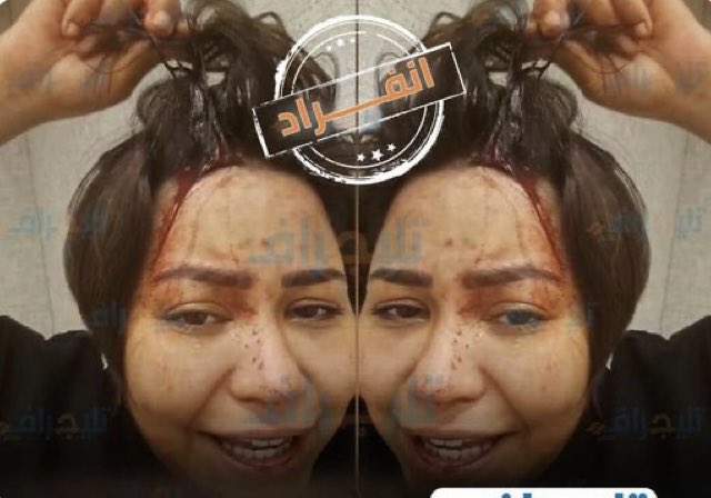 صوره شيرين عبد الوهاب بعد اعتداء حسام حبيب عليها 
المرأه الذكيه لا تثير الشفقه بل تثير الاعجاب 
يقولون الانثي جمال اقول الانثي كبرياء 
لانها تريد ان تعيش في ظل رجل وليس في ذل رجل 
اهزمي انكسار روحك وامضي في هذه الحياه امراه شجاعه