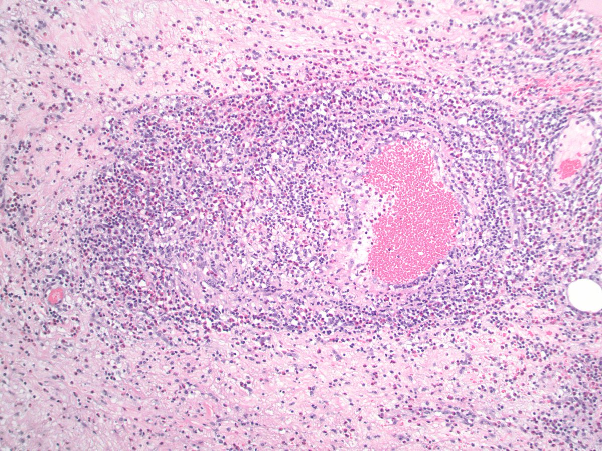 Bobbi Pritt, MD tweet media