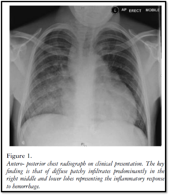 CardioCaribeMx's tweet image. Uso de factor VIIa para hemoptisis en Fontan
DOI 10.1017/S1047951117001007
#SPC #complexproblemsolving