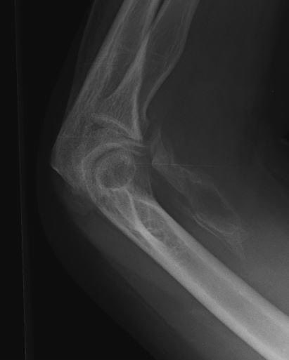 hemo_shk's tweet image. #Case
#Radiograph 
A 25 years old male with of falling down accident of two and half months.
Q1) What is your radiographic finding and diagnosis?
Q2) What is the management option?

#orthopedic 

🔹

#MedX #MedEd #MEDHM 
@IhabFathiSulima