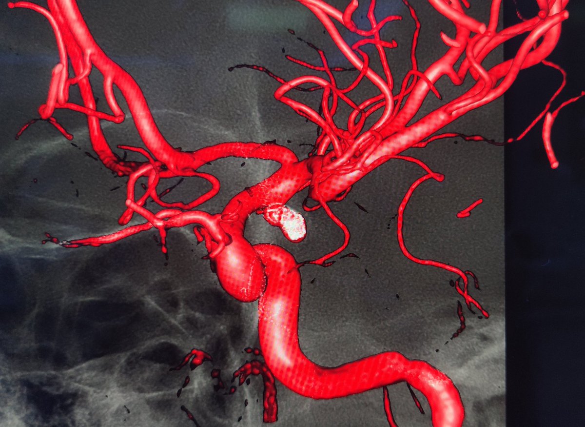 SAH F4, HH2 due to rupture elongated Pcom an. Helix coils alone instead of 3D frame adapts better to the morfology of this long aneurysm. 
High morbi-mortality picture of SAH, damage control thinking. 
¿Endo surgery? 40min and fast recovery. 
¿Open surgery? 2-3h and wound healing
