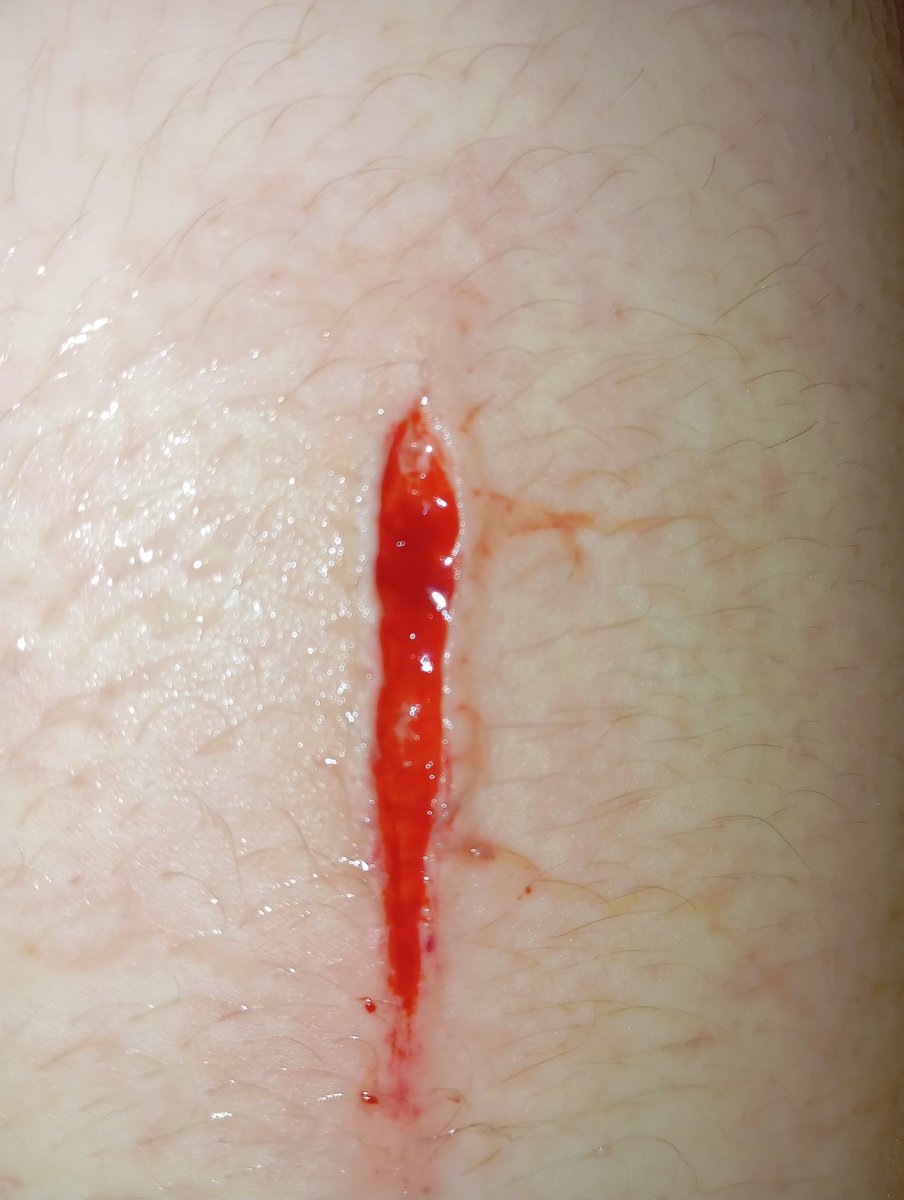 lus_corpse's tweet photo. New cut!!! #sh #shtwt #selfharm #selfharmpics #blood #bloodkink #bloodybath #bloodywater #cut #deepcut #hitthestyro #blade #slut https://t.co/yIevjklEG6