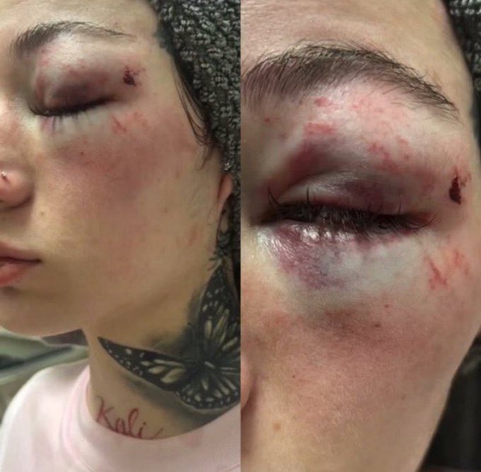 itsKenBarbie's tweet photo. ⚠️ TRIGGER WARNING ⚠️| Danielle Bregoli (aka Bhad Bhabie) posted a video of her baby father LV physically abusing her to her IG story. She then posted photos with a black eye before alleging that he’s doing all of this to her, but trying to take custody of their child. 🤯 https://t.co/UxlOj6dOpR