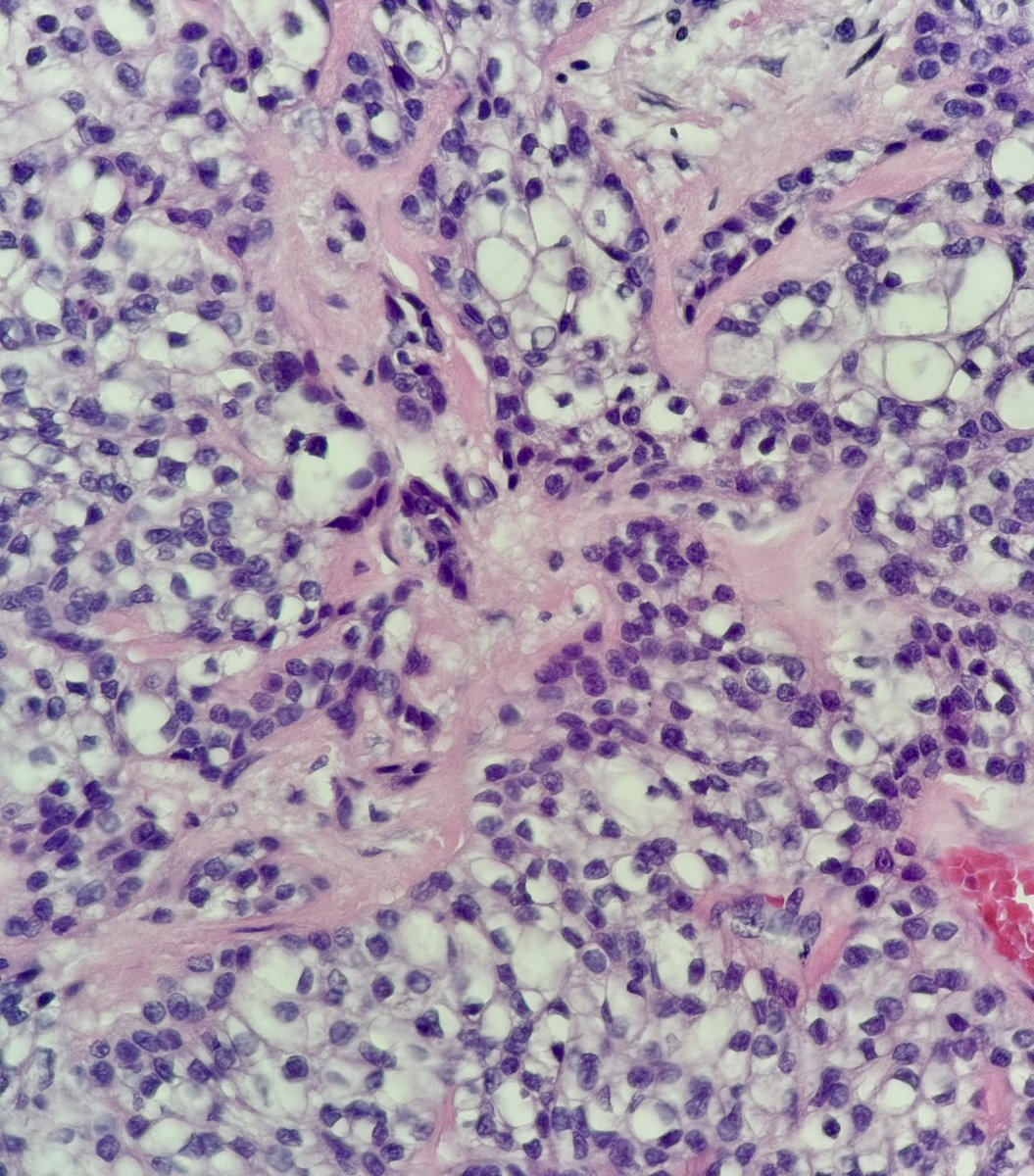bruno_sedassari's tweet photo. Biopsy of a tonsillar pillar tumor in a 53-year-old woman. What differential diagnoses should we consider? #PathTwitter #ENTPath #OraPath #pathology https://t.co/chg12BPjDo