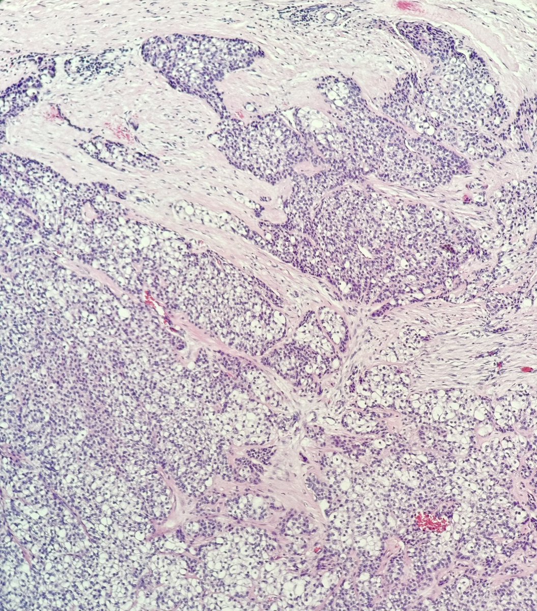 bruno_sedassari's tweet photo. Biopsy of a tonsillar pillar tumor in a 53-year-old woman. What differential diagnoses should we consider? #PathTwitter #ENTPath #OraPath #pathology https://t.co/chg12BPjDo
