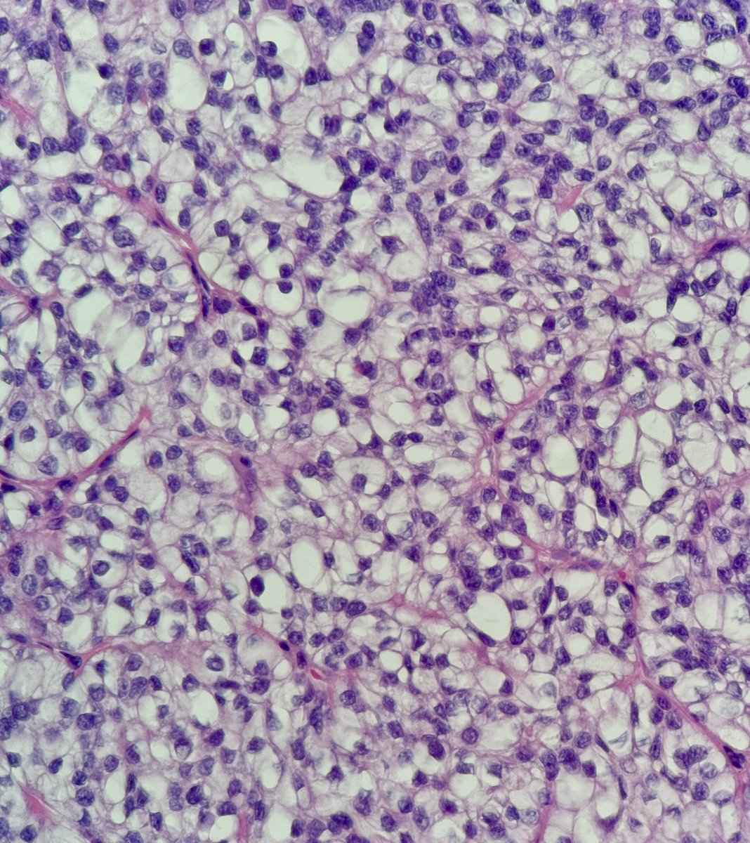 bruno_sedassari's tweet photo. Biopsy of a tonsillar pillar tumor in a 53-year-old woman. What differential diagnoses should we consider? #PathTwitter #ENTPath #OraPath #pathology https://t.co/chg12BPjDo