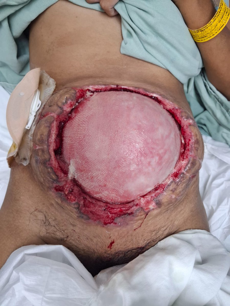 migueriv69's tweet photo. fem d 22a
emb 20 sem
salmonelosis con perforacion ileal a 2mts d treiz
ileostomia con gasto d 4mil
evicerada en varias ocasiones
c dejaria bogota hasta k pariera
pero c coloca vac granula e hidrocoloide

manejo ambulatorio para mejorar nutricion
con solo proteina sin fibra y lope https://t.co/ic2LdqUVTj